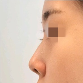 콧대(보형물) 후기