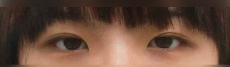 쌍꺼풀(매몰) 후기