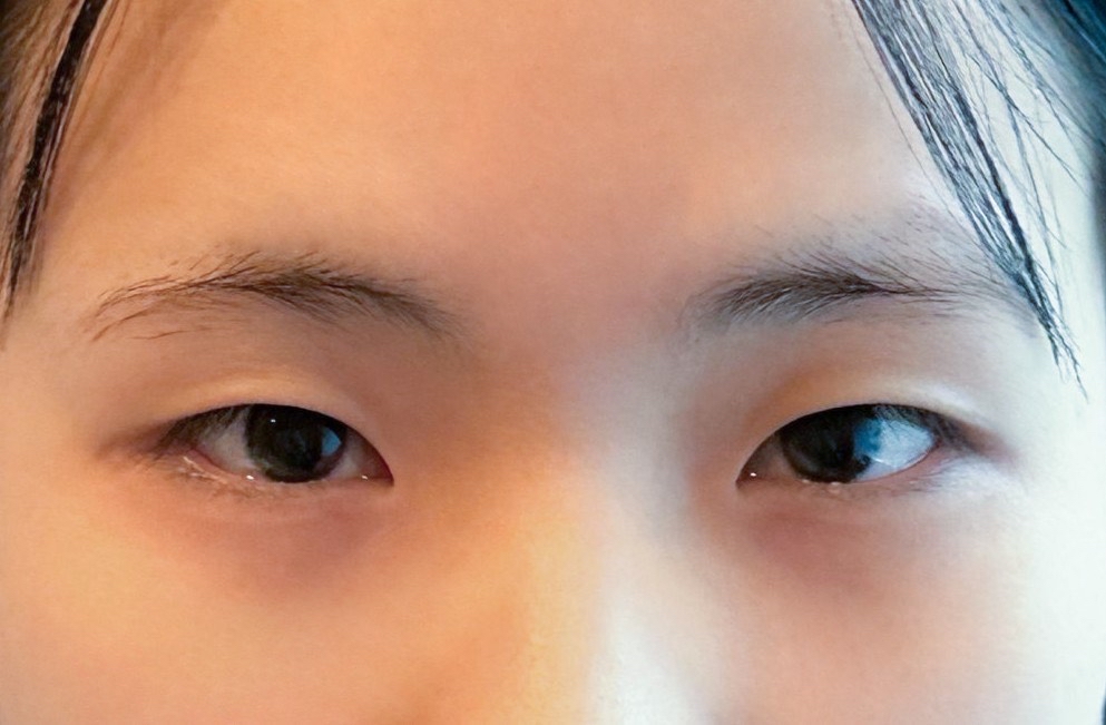 쌍꺼풀(절개) 후기