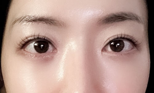 쌍꺼풀(자연유착) 후기