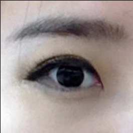 앞트임 후기