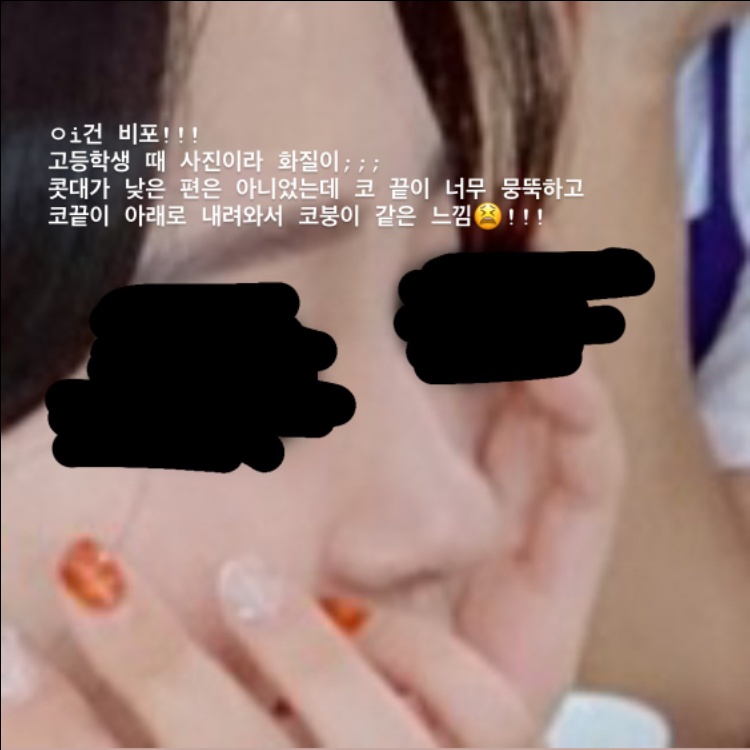 콧볼축소 후기