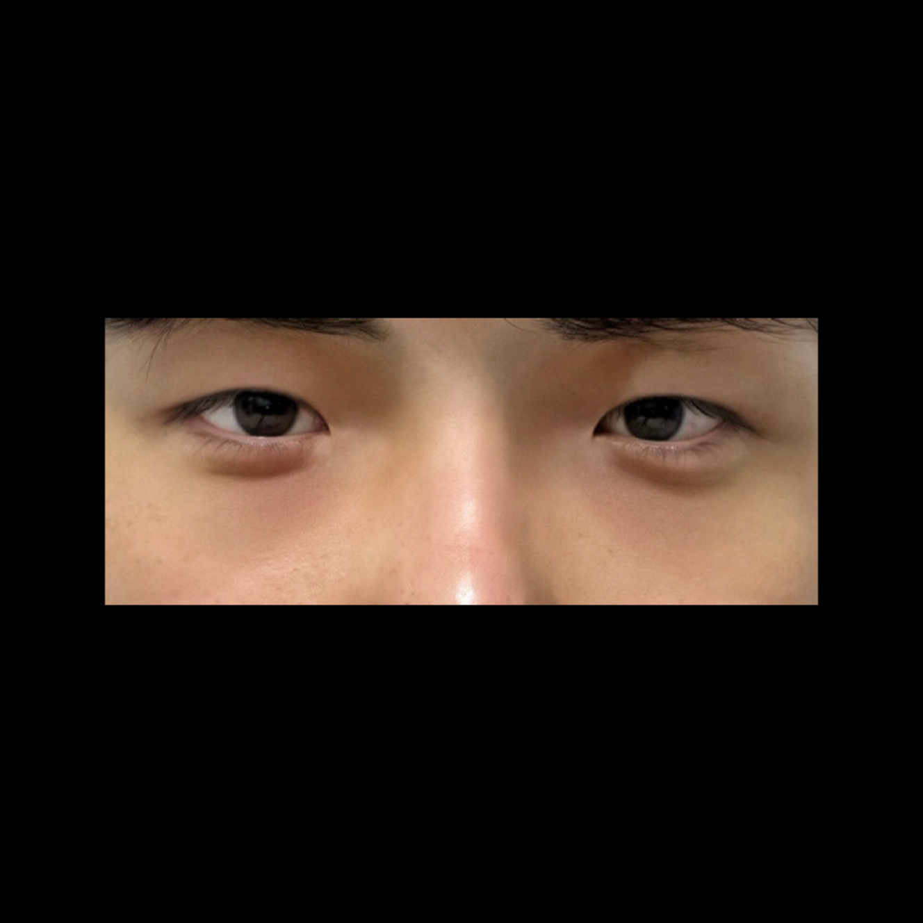 쌍꺼풀(매몰) 후기