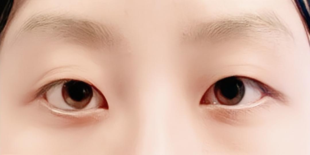 밑트임 후기