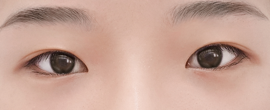 눈재수술 후기