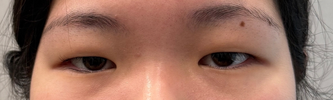 쌍꺼풀(절개) 후기