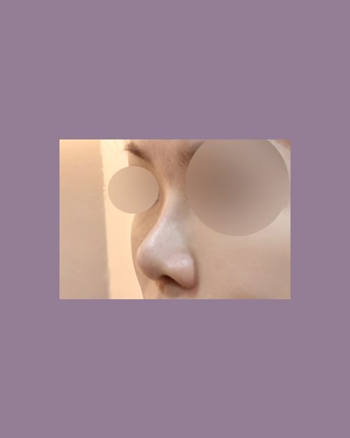 코재수술 후기