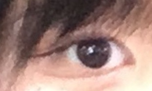 뒤트임 후기