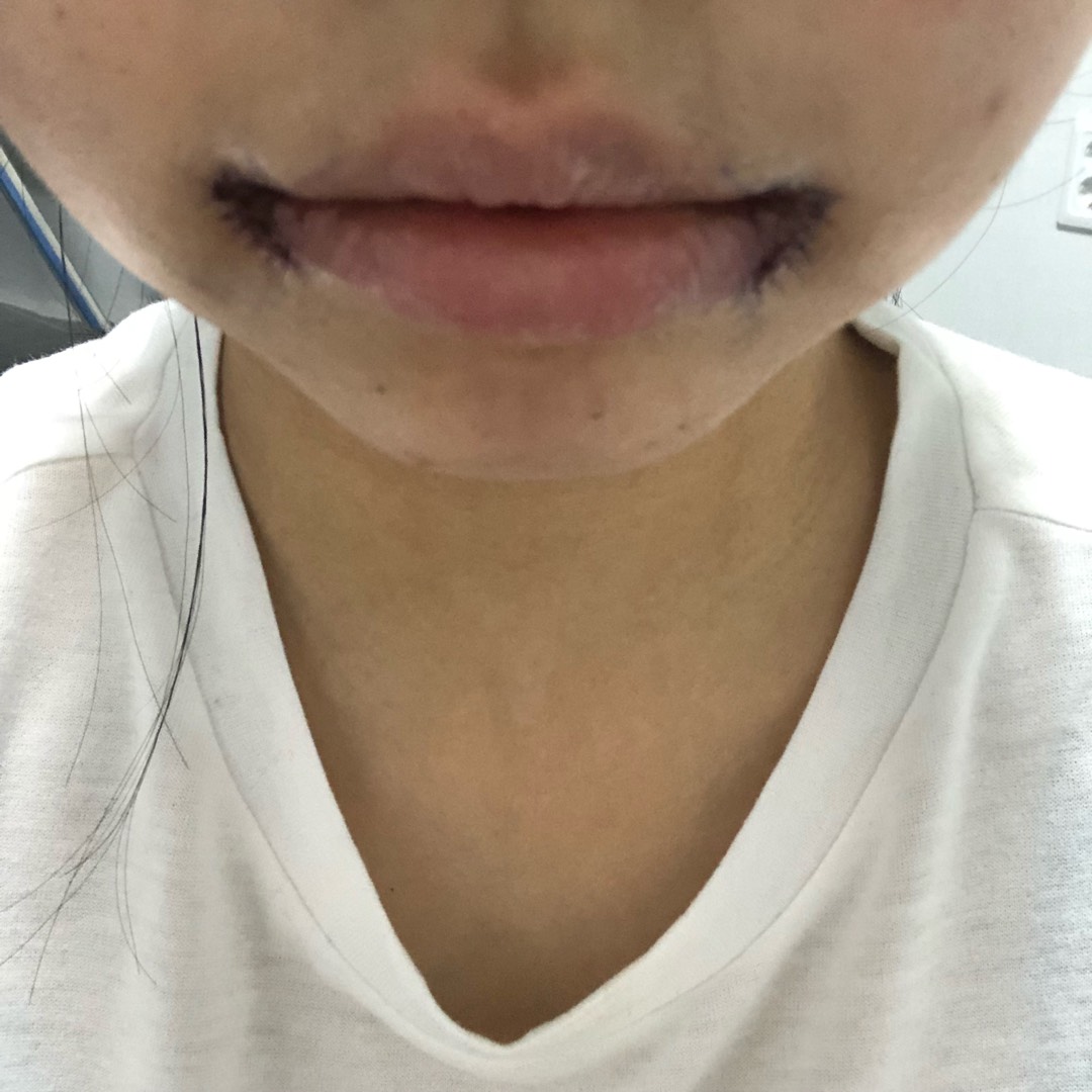입꼬리성형 후기
