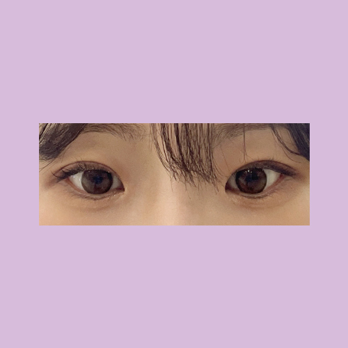 밑트임 후기