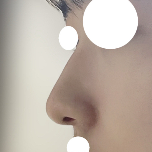 콧대(보형물) 후기