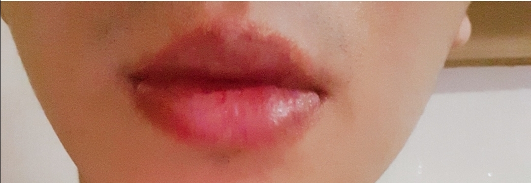 입꼬리성형 후기