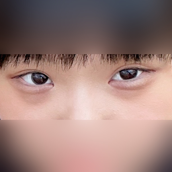 눈밑지방재배치 후기