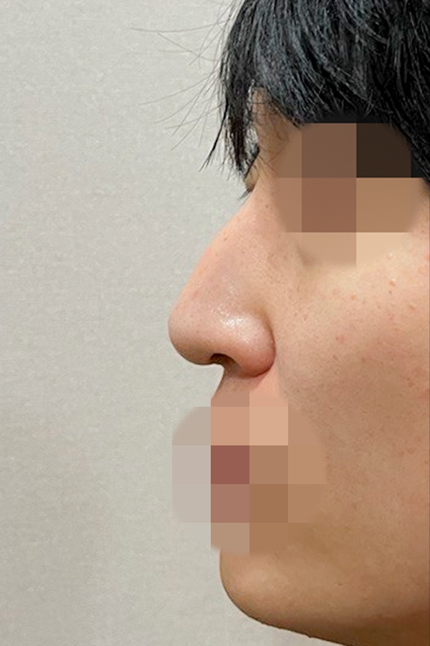 콧대(보형물) 후기