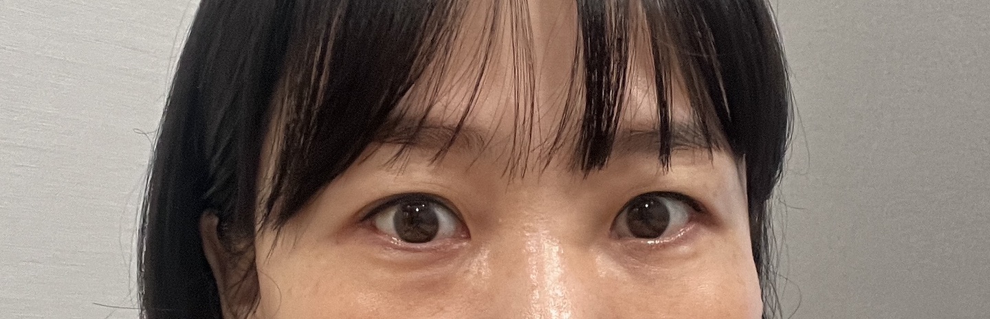 눈썹거상술 후기