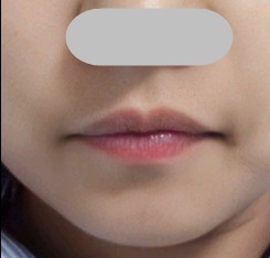 입꼬리성형 후기