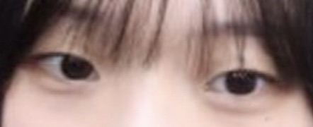 쌍꺼풀(매몰) 후기