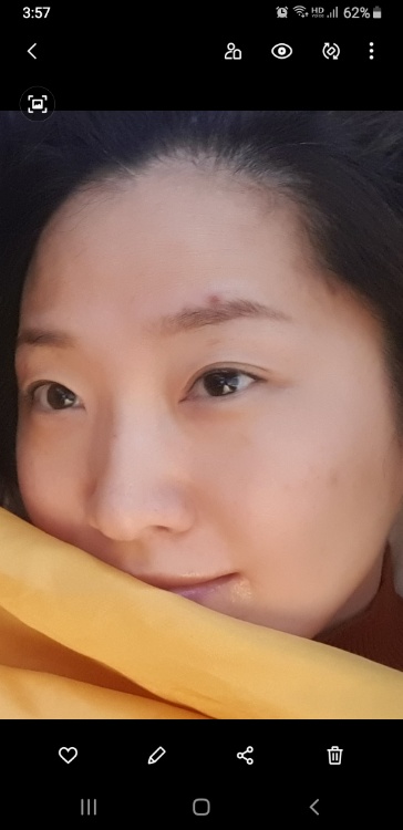 쌍꺼풀(절개) 후기