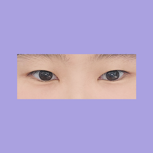 쌍꺼풀(자연유착) 후기