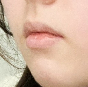 입꼬리성형 후기