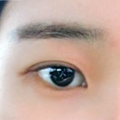 앞트임 후기