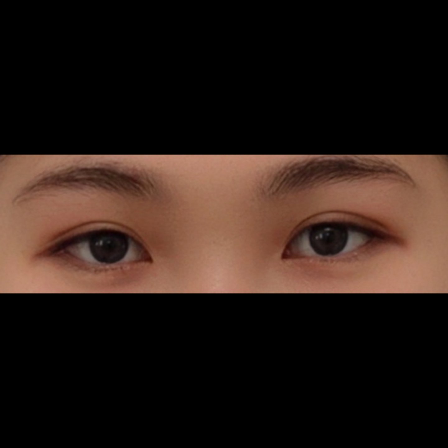 눈재수술 후기