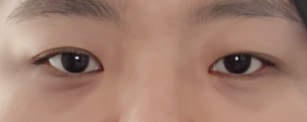 앞트임 후기
