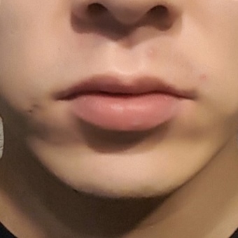 입꼬리성형 후기