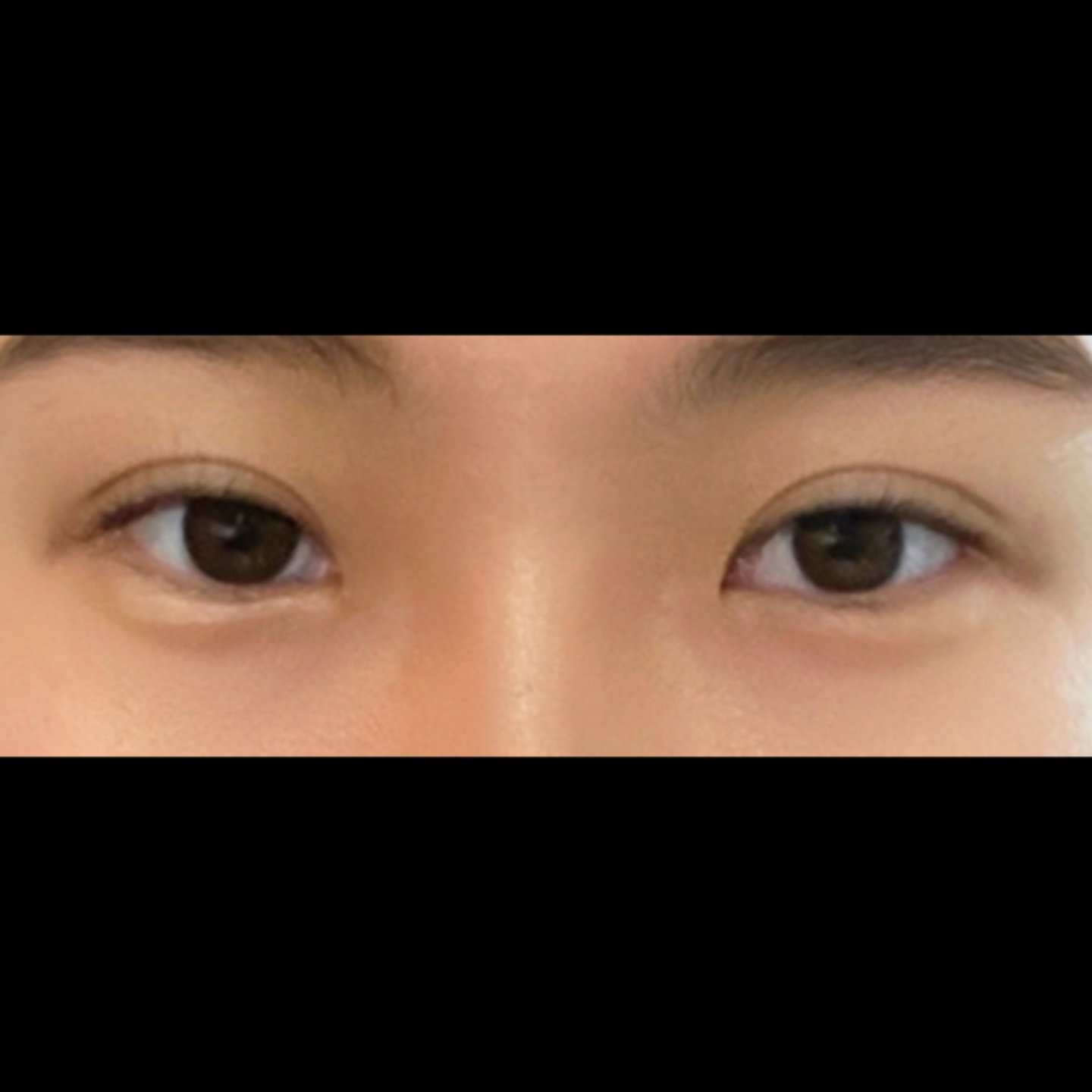 눈재수술 후기