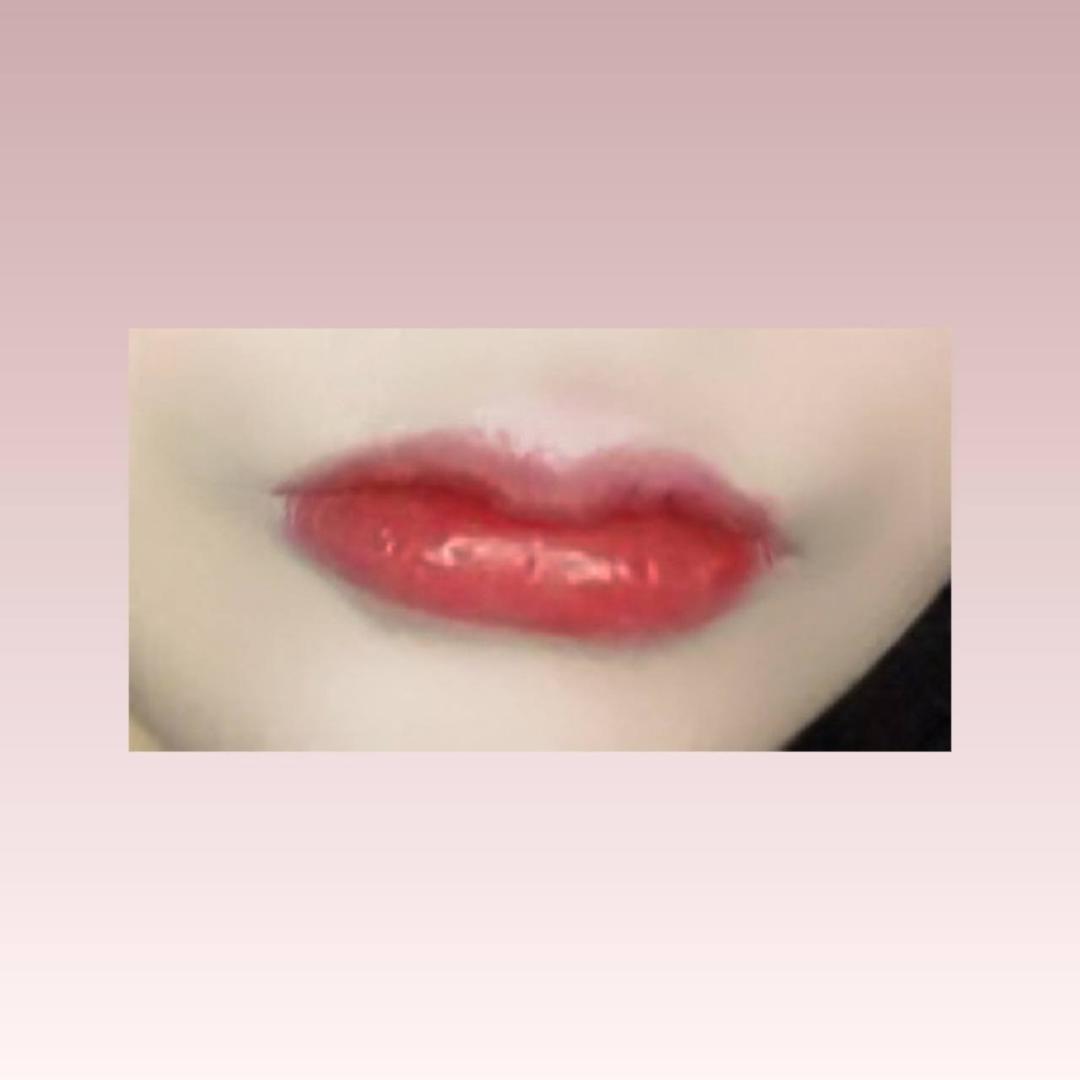 입꼬리성형 후기
