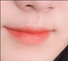 입꼬리성형 후기