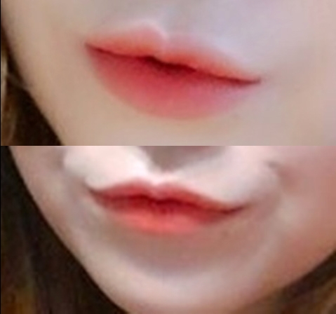 입꼬리성형 후기