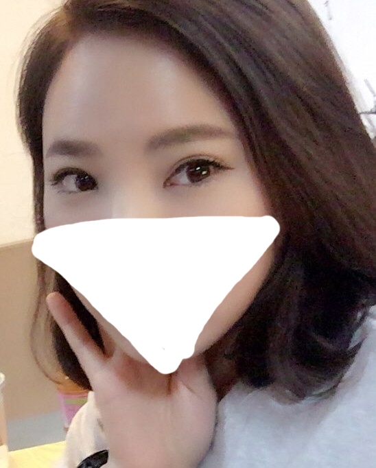 눈재수술 후기