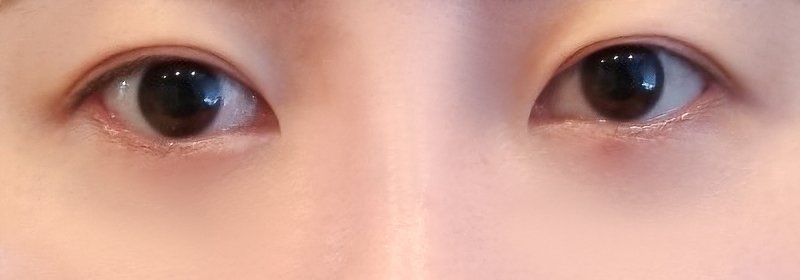 눈재수술 후기