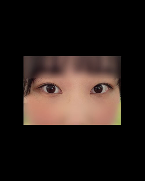 쌍꺼풀(자연유착) 후기