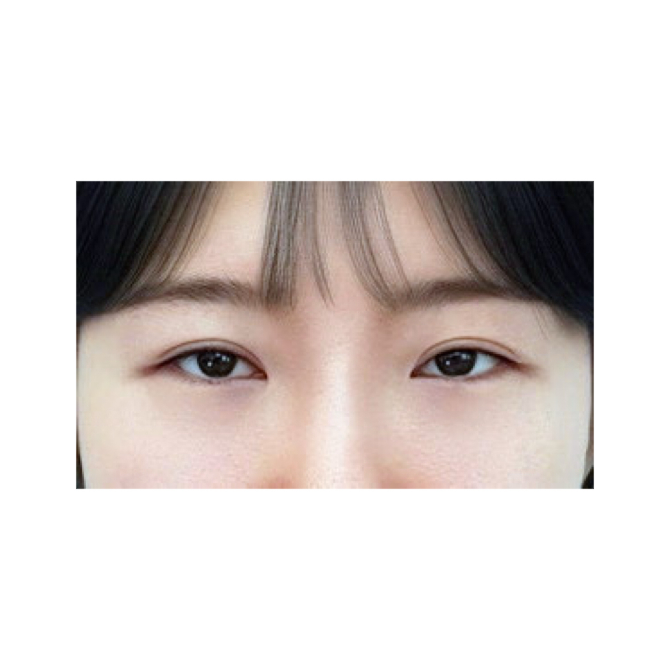 눈재수술 후기