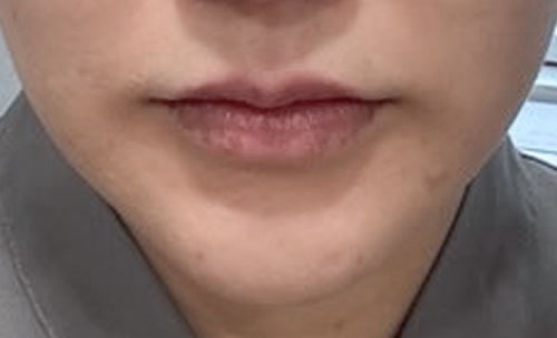 입꼬리성형 후기