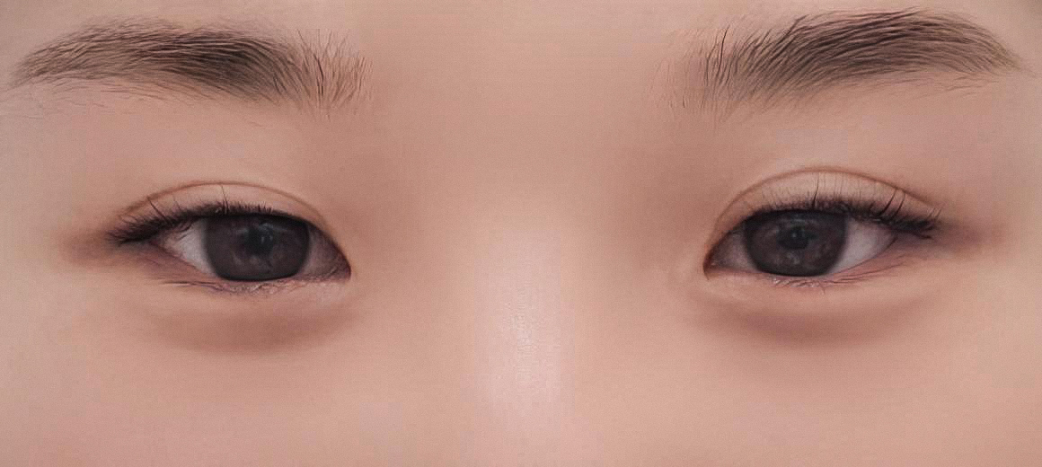 눈재수술 후기