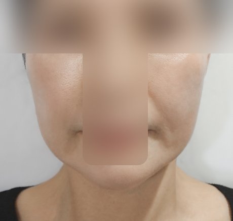 실리프팅 후기