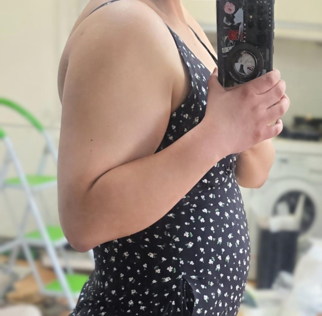 팔지방흡입 후기