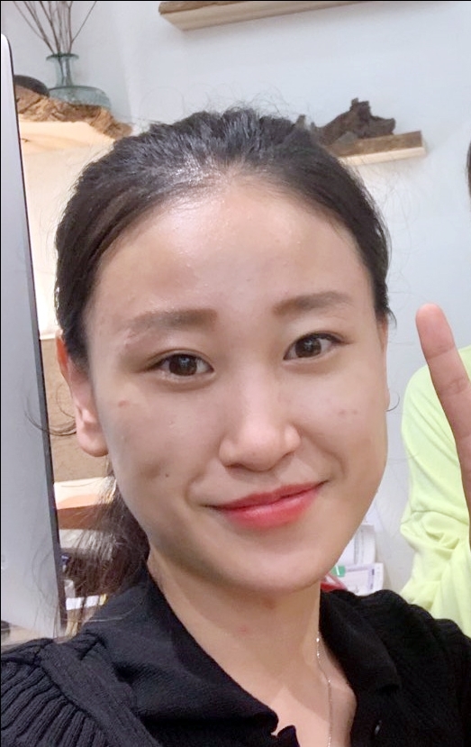 쌍꺼풀(절개) 후기