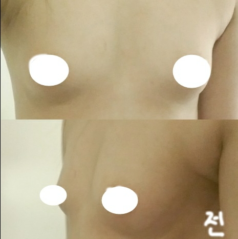 가슴(보형물) 후기