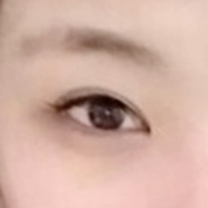 눈재수술 후기