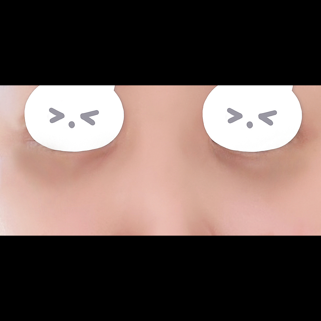 눈밑지방재배치 후기