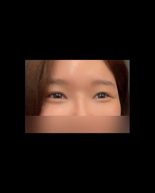 밑트임 후기