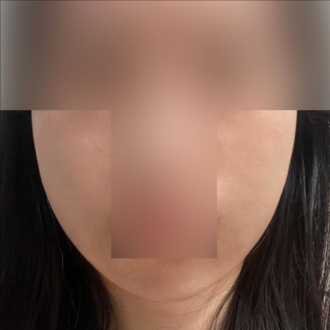 윤곽주사 후기