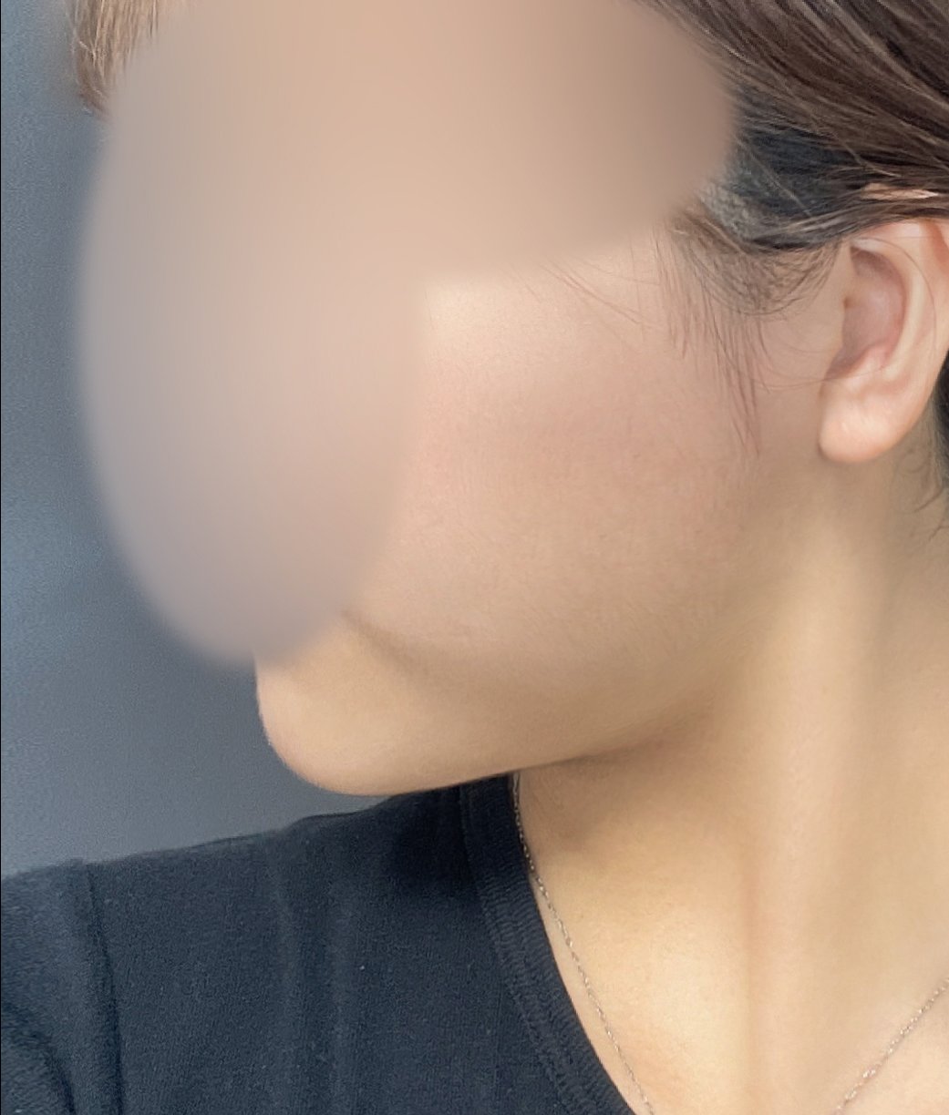 실리프팅 후기