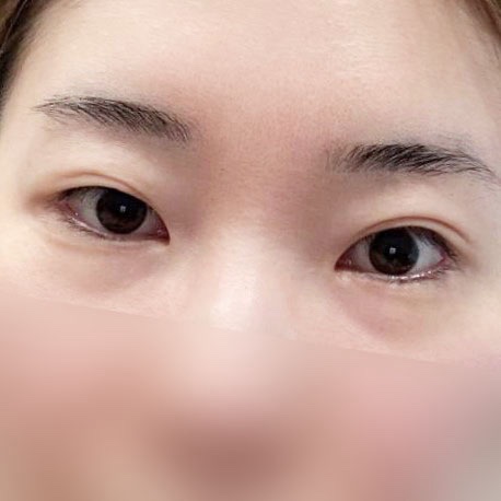 쌍꺼풀(절개) 후기