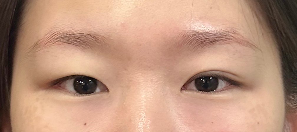 쌍꺼풀(절개) 후기