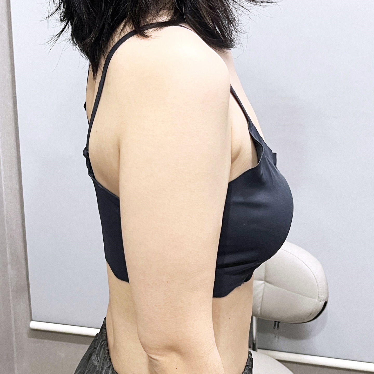 팔지방흡입 후기